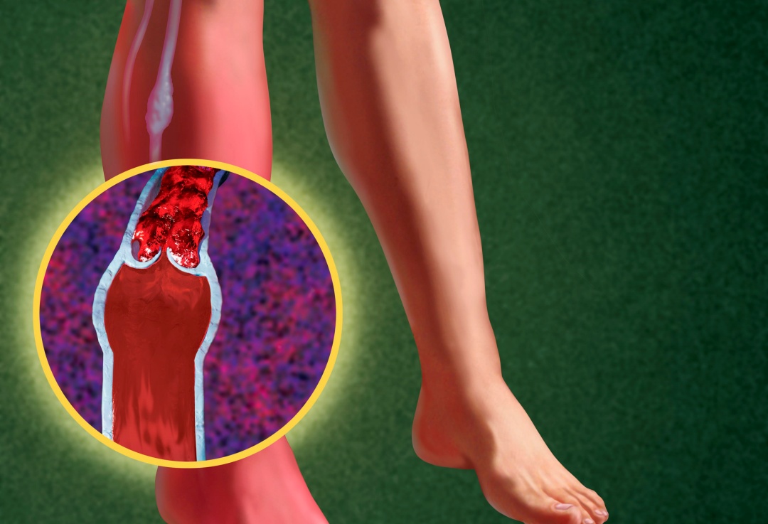 Dor nas pernas pode ser sinal de trombose venosa profunda - conheça os sinais, sintomas e tratamento